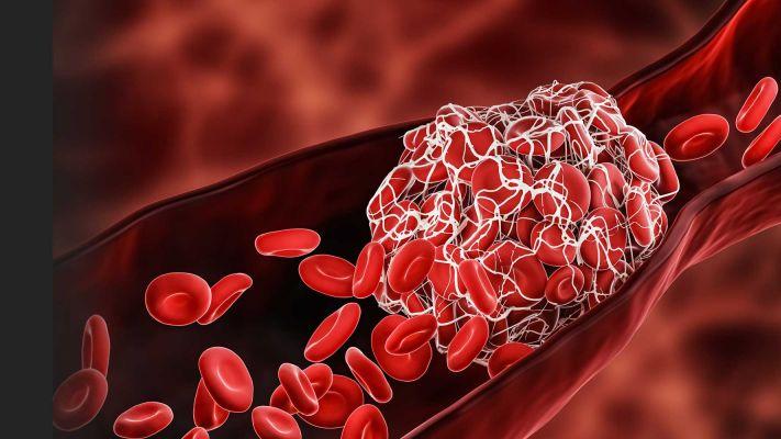 尿酸|关于血栓：当血凝块卡在关键器官或区域时会发生哪些情况？