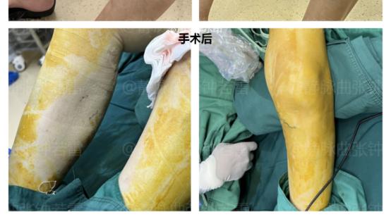 静脉曲张|人体遍布静脉，为何唯独下肢静脉曲张常见？老钟带你探个究竟