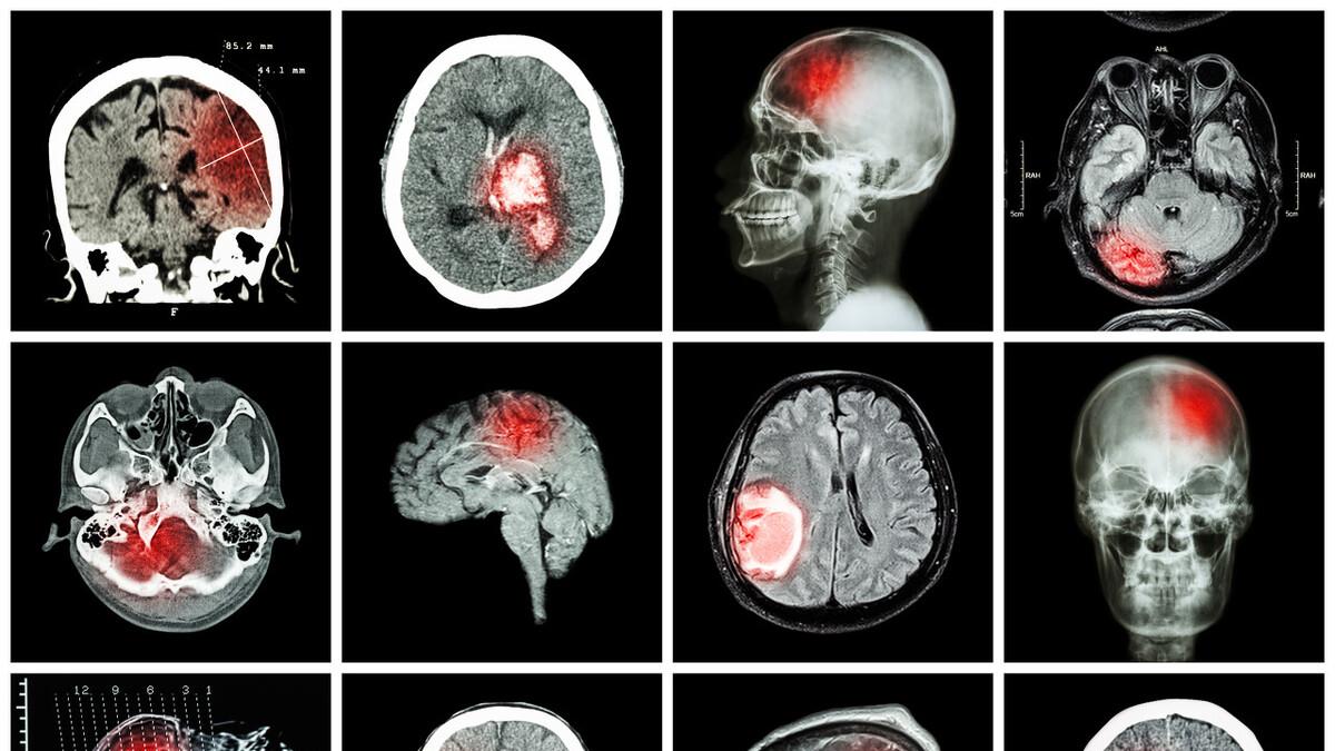 脑梗|脑子里有痰，脑梗！心脏里有痰，心梗！参考一方两味药，化痰解梗