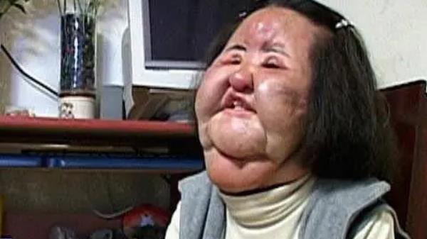 韩慧景|女星韩慧景：为了更漂亮，给脸注射食用油，把脸整成“猪头”