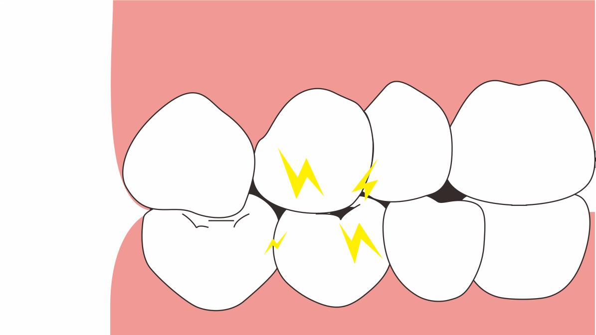 睡眠|?晚上睡觉磨牙居然有这么多危害！快转给你身边有这个习惯的人