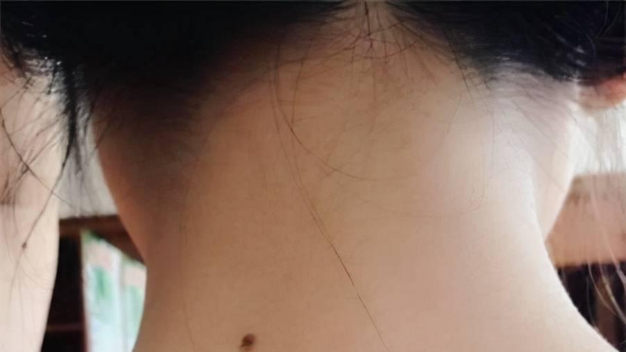 许多|易被忽视的痣，却能看出健康问题？长成这样子的痣，不是好迹象