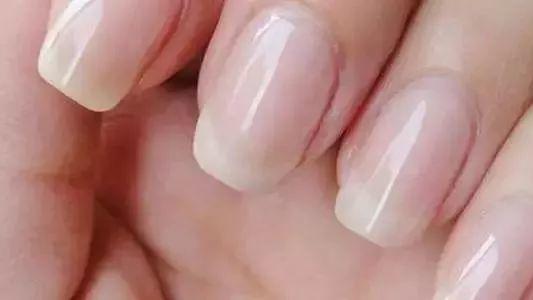 牙齿|皮防科普 | 指甲上的月牙、竖纹代表什么？