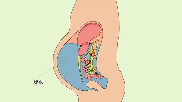 肿瘤|癌症患者出现腹水只能活数月甚至几周？如何祛除腹水扭转逆局！