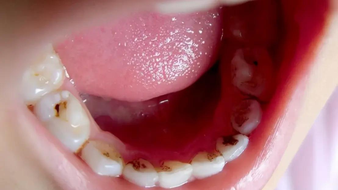 牙齿|10岁娃用“牙洞修复牙膏”后损失6颗牙，这种智商税可别再交了