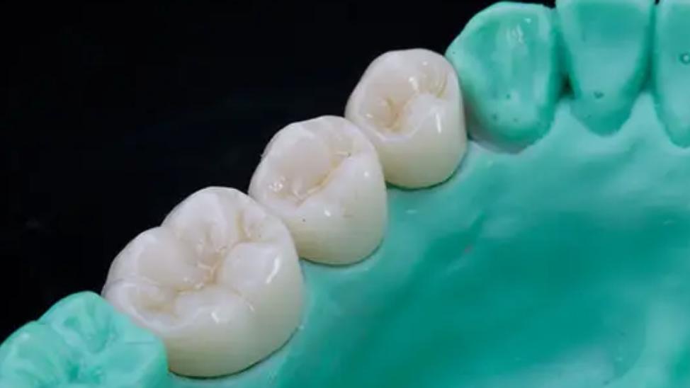 牙齿|为什么良心牙医不建议做全瓷牙？