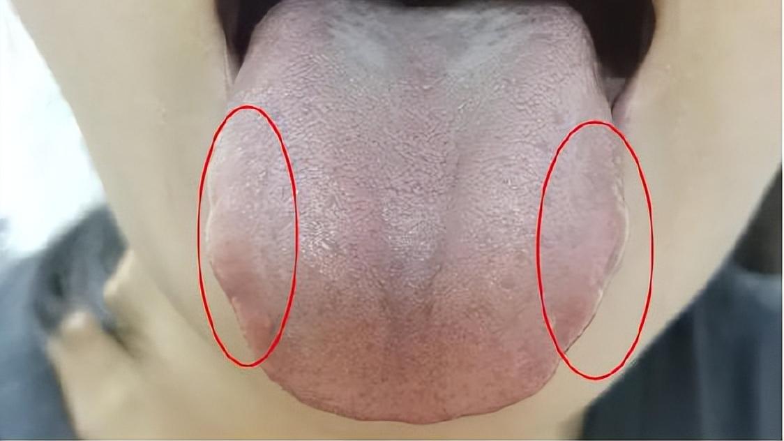 咽炎|咽干、咽痛、咽部异物感，慢性咽炎怎么治？四个小方法统统调理好