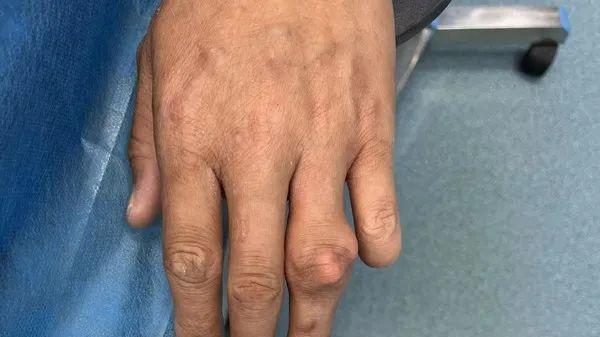 痛风|怎样溶解痛风石？吃药能溶解吗？