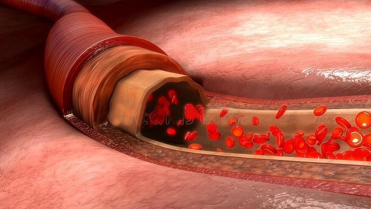 养生|人体血管寿命有多长，人的生命就有多长，如何才能延长血管生命？