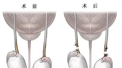 男人结扎之后, 会影响性功能吗?
