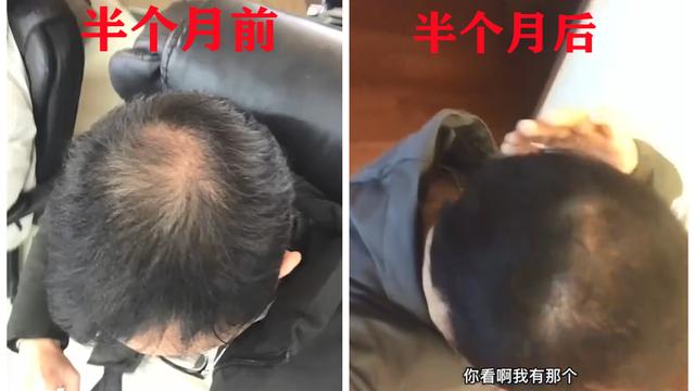 秃顶|新奇！男子秃顶求医无效，半个月不用洗发水竟长出头发：又粗又硬