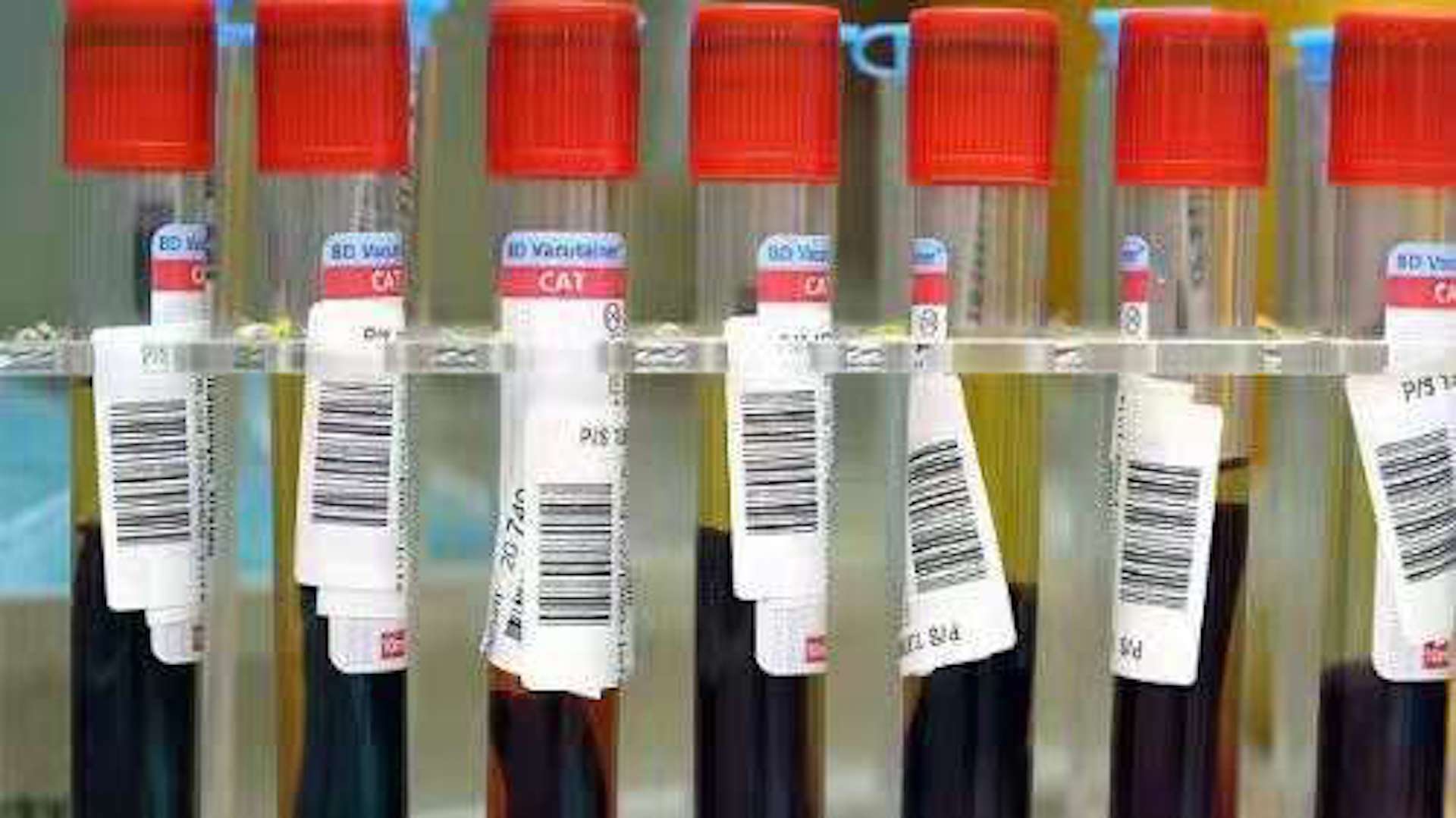 脾胃|40岁以上血脂高，甘油三脂和胆固醇哪个升高危害大？二者啥关系？