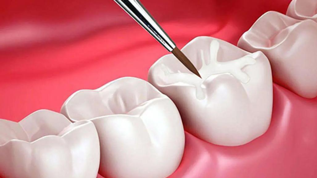 脑出血|正畸治疗前为什么需要补牙？
