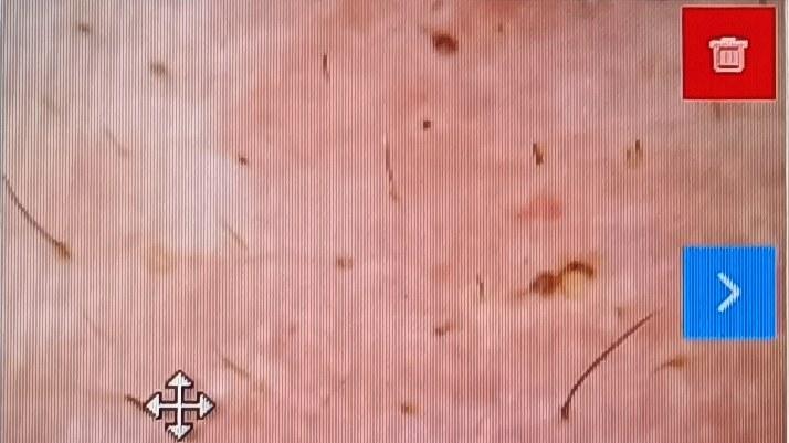 医院|“缠腰蛇”带状疱疹痛如刀割，怎么治好得快？3个方法可快速治疗