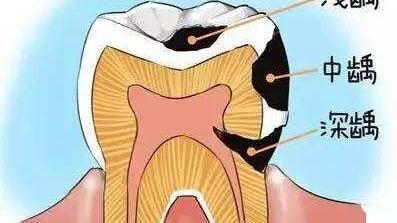 牙齿|科普：健康需要一口好的牙齿，吃嘛嘛香