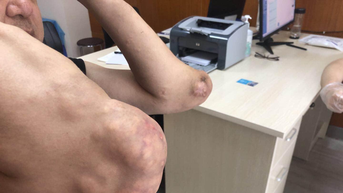 便秘|高尿酸患者应该这样吃早餐