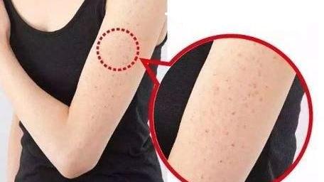 粉底 出现这种情况，可能是“鸡皮肤”，别不当回事