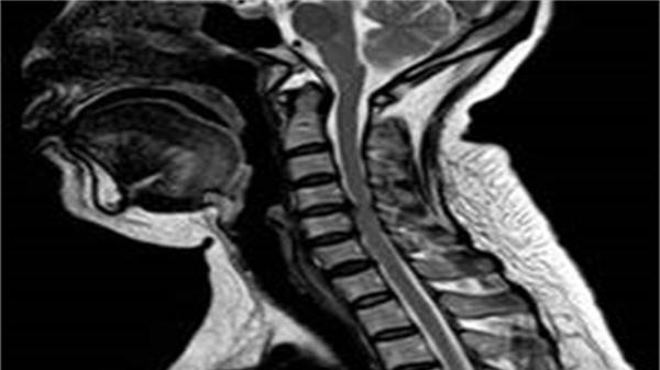 医生|颈椎管狭窄是什么？会带来什么危害？