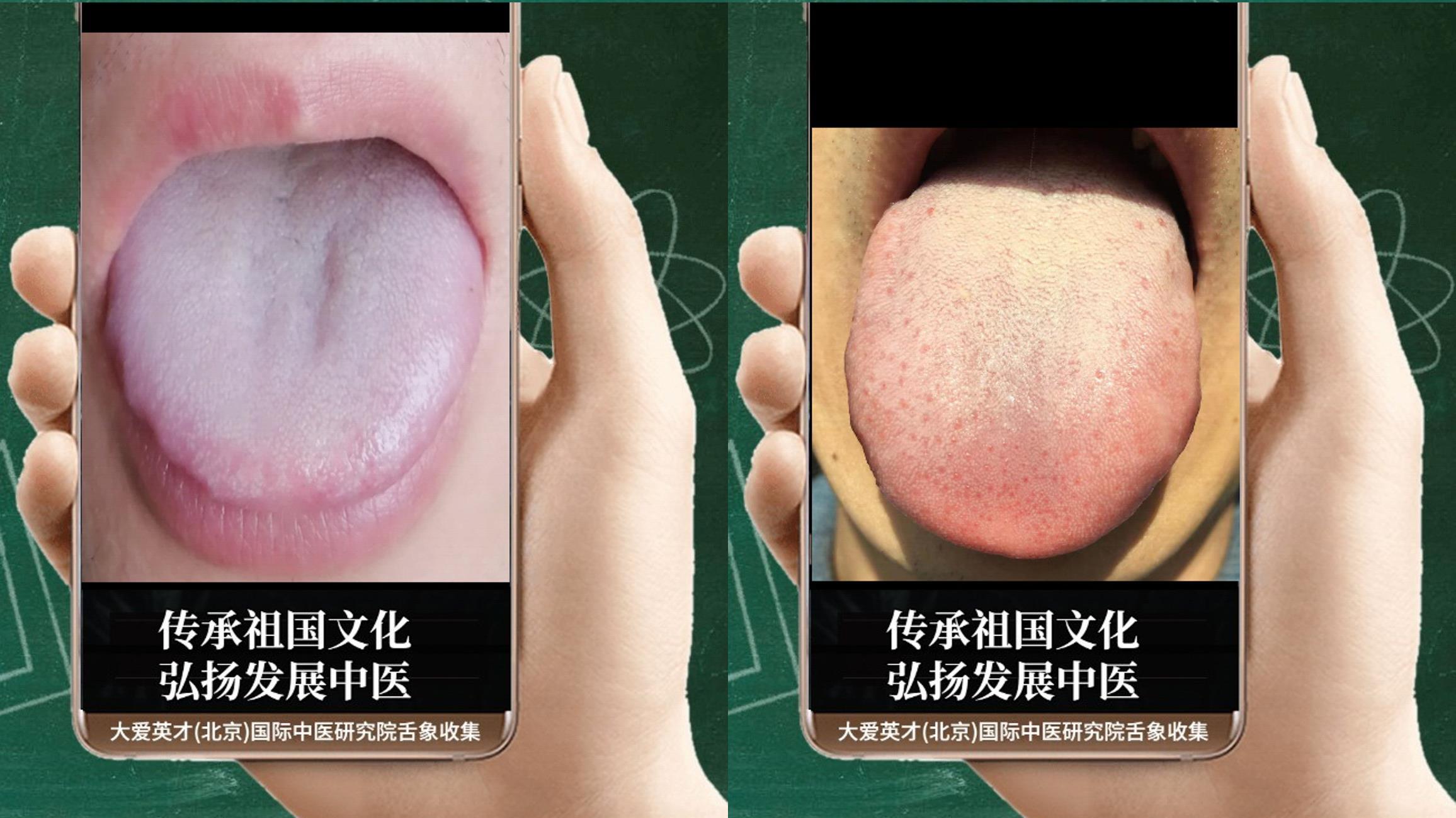 疾病|中医实解：打嗝呃逆，手足心热，痰阻于心，气滞不降