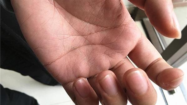 肾虚|不知道自己是不是肾虚？看看手脚或许就知道