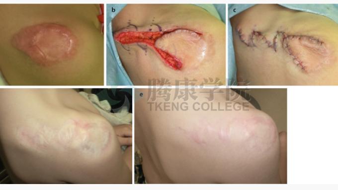 皮炎|皮质类固醇贴剂治疗瘢痕疙瘩和增生性瘢痕