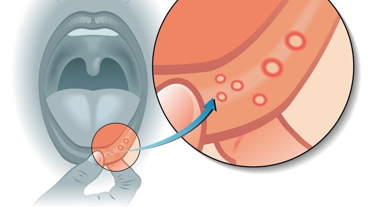 排便|体内有癌，嘴巴先知？口腔若出现3个迹象，可能是癌症来临的信号