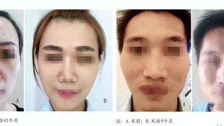 抗衰老 干细胞在美容方面的运用，亲身案例，实现面部年轻化