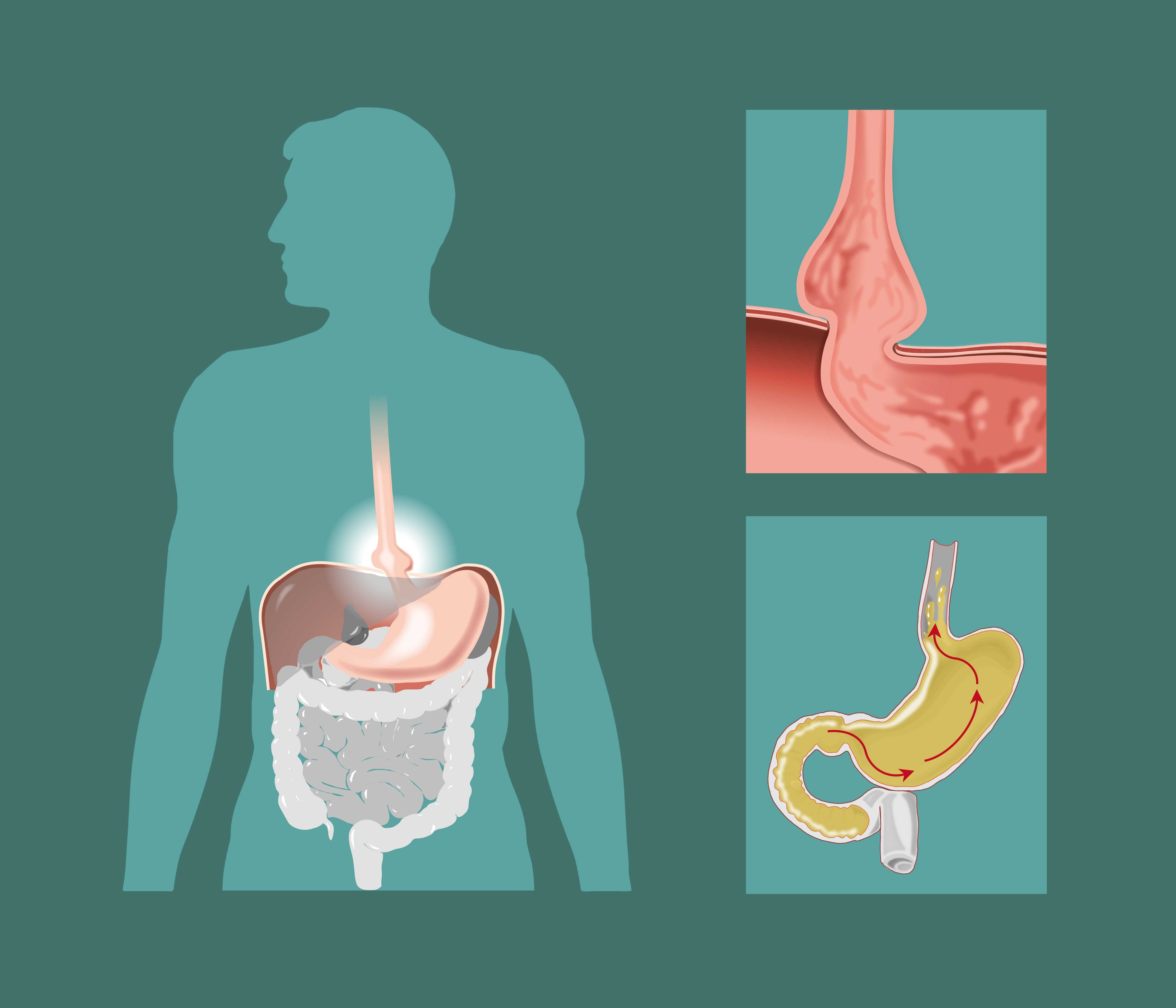 肠胃|这5个饮食习惯，会损伤肠胃，肠胃功能弱的人，需重视