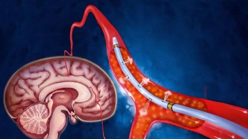 脑梗|为啥中国脑梗患者越来越多？医生：与肥肉无关，三种调料请少用