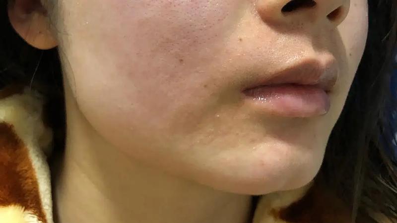 皮肤屏障受损=敏感肌？你也这样认为吗？