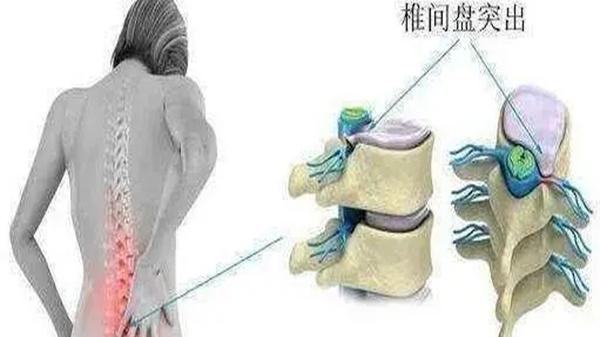 失眠|关于腰椎间盘突出症，你都了解哪些知识？