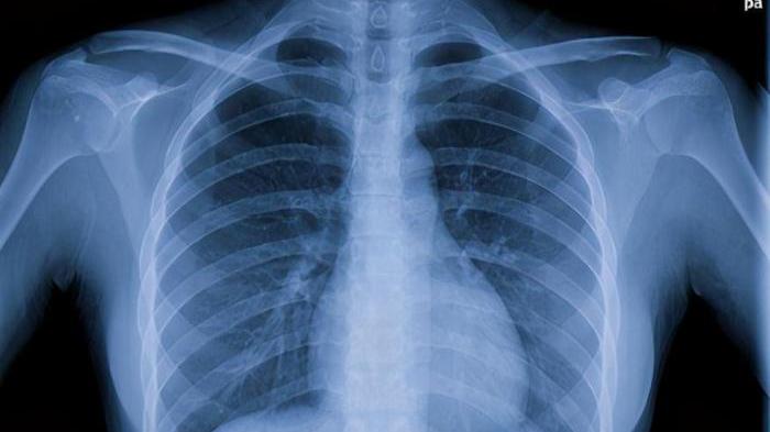 疾病|甲乳科医生提醒：甲状腺结节的人，最好3件事，帮助消炎散结