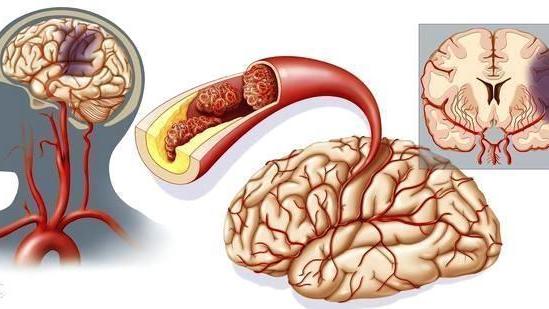 尿酸|除了脑中风，颈动脉斑块脱落的危害非常大！想不得病请牢记这3招