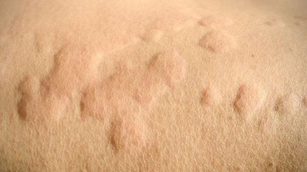 荨麻疹|荨麻疹找上门，或与这4个因素有关，要做好预防，别大意