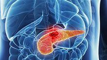 胰腺癌|长期喝咖啡当心惹上胰腺癌 在生活中预防胰腺癌