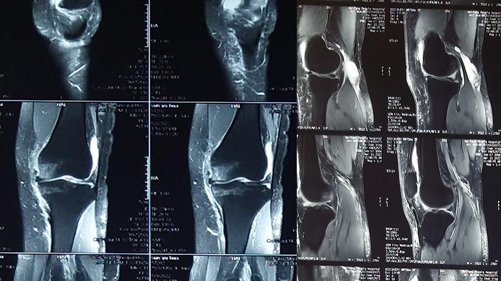 中草药|与大家分享关于中医骨科治疗“膝盖疼”的案例