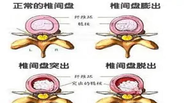 红枣|只有中老年人才会腰突？腰突年轻化趋势明显