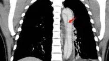 主动脉夹层|一招除“虎患”！石门县人民医院成功救治两例主动脉夹层患者