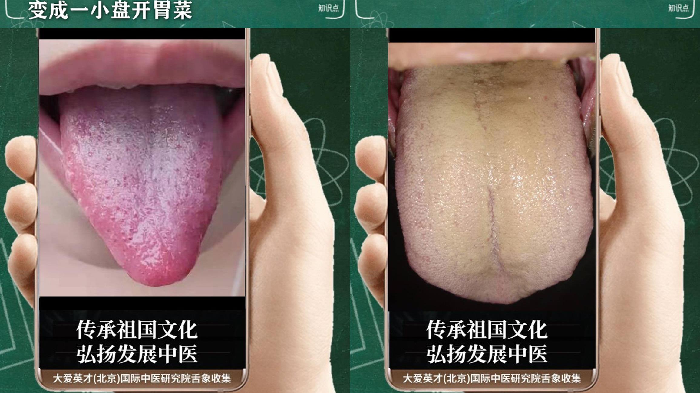 甲状腺结节|中医实例：易爆躁、食欲差、胸闷痰多、不断反复很难受