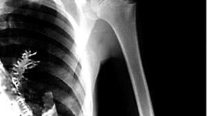 蛋白质|男子被查出肺癌，手术时医生在他肺里发现一棵树，肺真的能长树吗