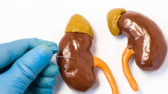 肾病|肾病多年4次复发！如今指标好转恢复正常生活，为他高兴