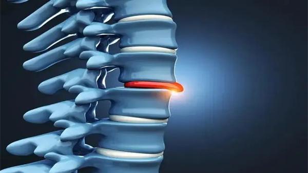 腰椎间盘突出|腰突患者日常要好好保养，避免病情加重