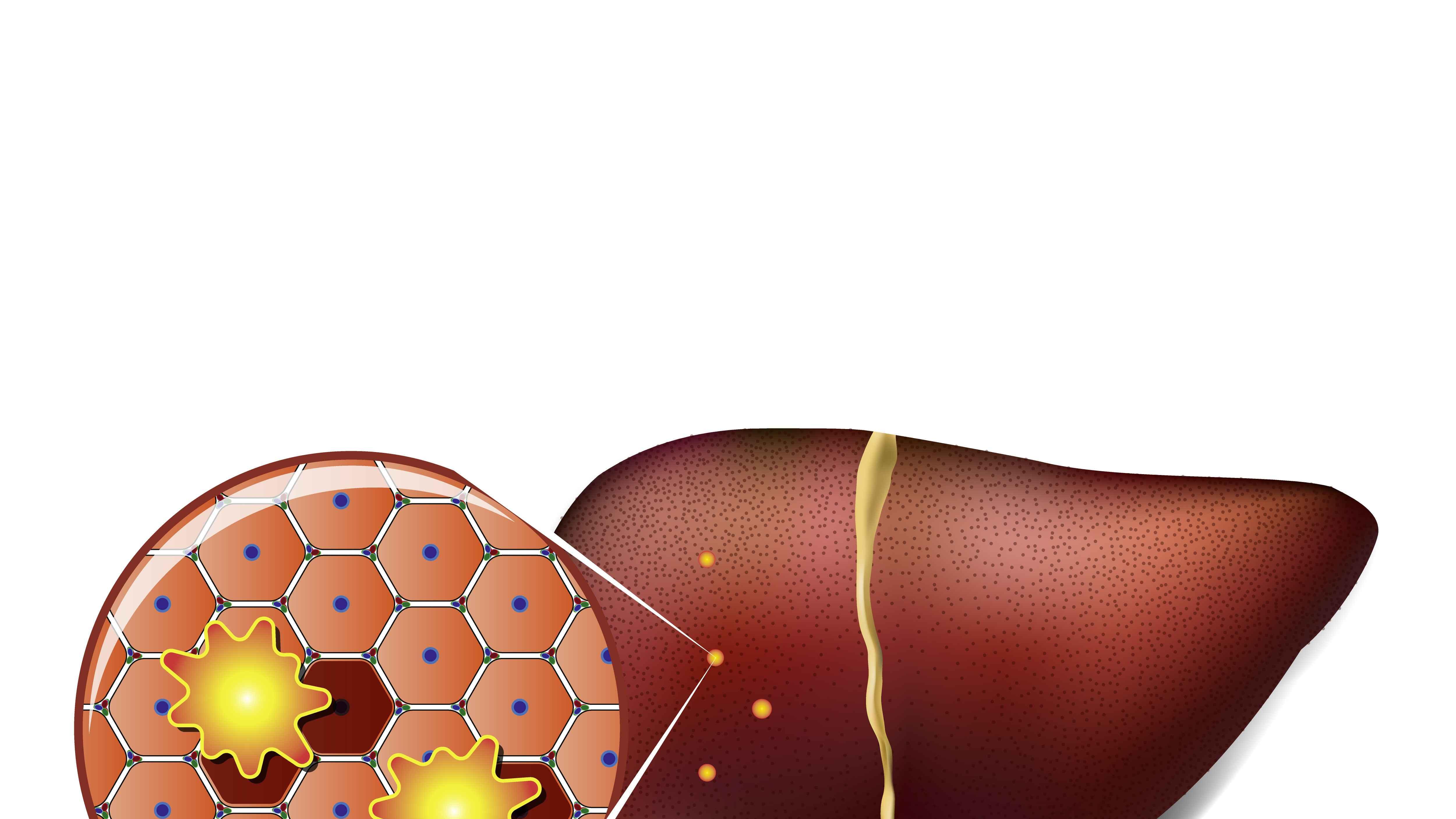 脂肪肝|?查出脂肪肝后，饮食要遵循这6个原则，或能让肝功能慢慢恢复