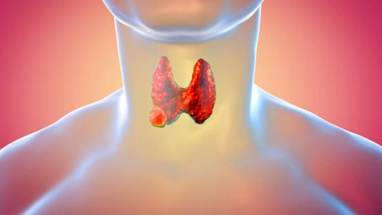 甲状腺疾病|甲状腺癌多是“拖”出来的？卫生组织呼吁：身体若有3种表现，尽早就医