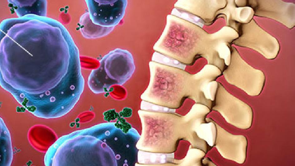 |多发性骨髓瘤新药teclistamab获欧盟批准：治疗复发或难治性患者