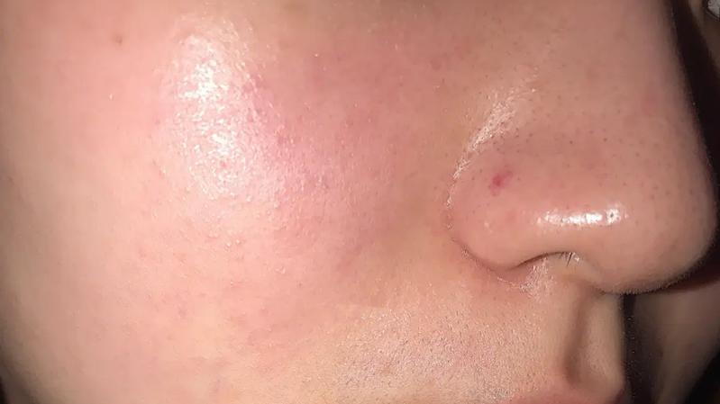 蛋白质 怎么判断自己是不是敏感肌？皮肤容易泛红、刺痛的，快点进来看！