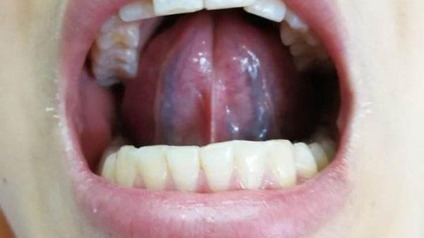 |舌下有青筋，是怎么回事？青筋出现这2种异常时，可能是疾病信号