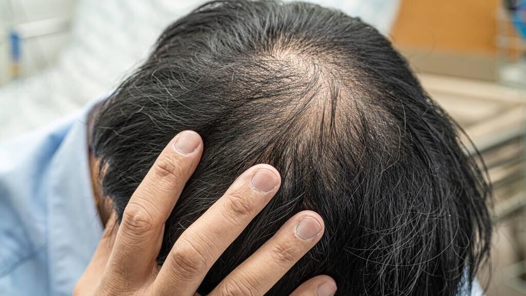 中药|须发早白、脱发谢顶，参考一个中成药，白发黑了，头发也长回来了