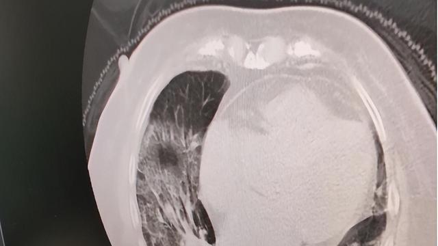 水果|新冠“老旧株”在我国“复出”？专家谈3个真相