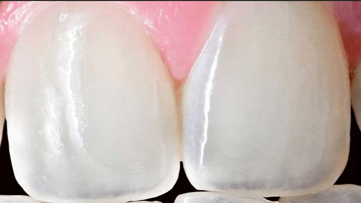 牙齿|牙釉质到底能不能再生？
